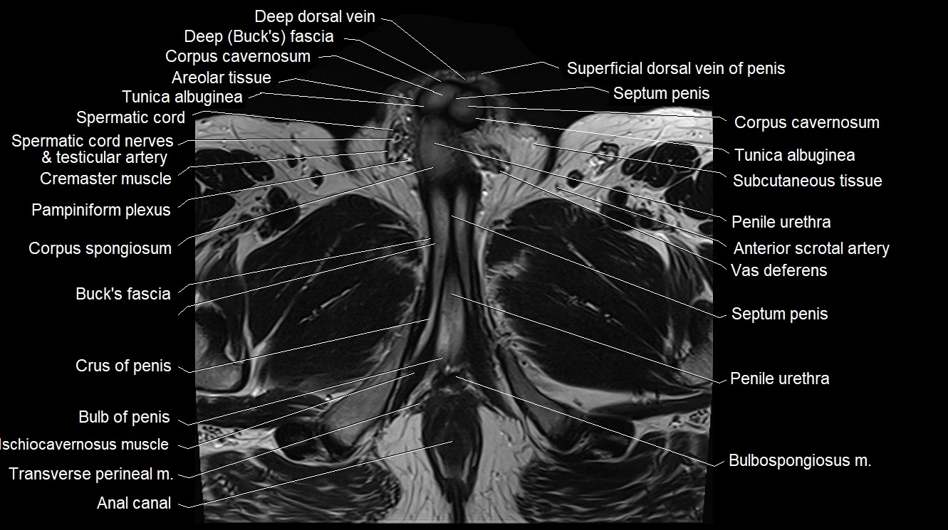 MRI 3T scrotum and penis axial cross sectional anatomy image 19.webp